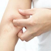 Solutions naturelles pour l'eczéma atopique et les démangeaisons