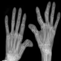 Les Remèdes Naturels pour Soulager les Symptômes de la Polyarthrite Rhumatoïde